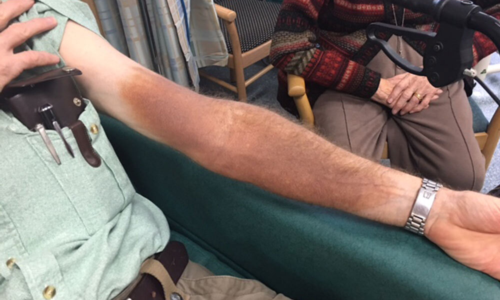 Iron Infusion